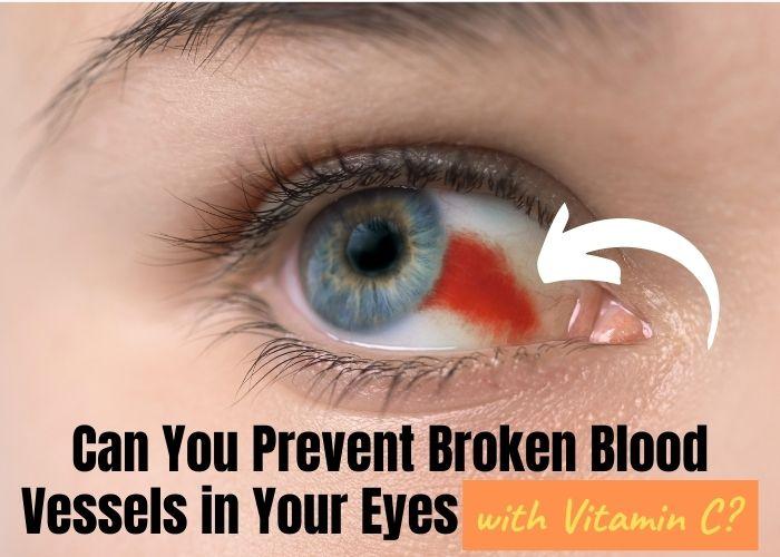 how-to-prevent-broken-blood-vessels-in-eyes-with-vitamin-c